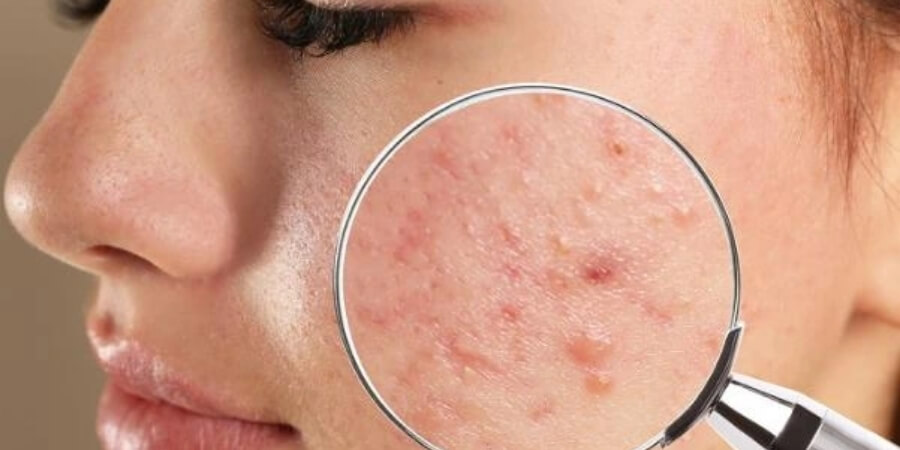 Xem thêm chi tiết tinh dầu bưởi Hỗ trợ trị mụn trứng cá